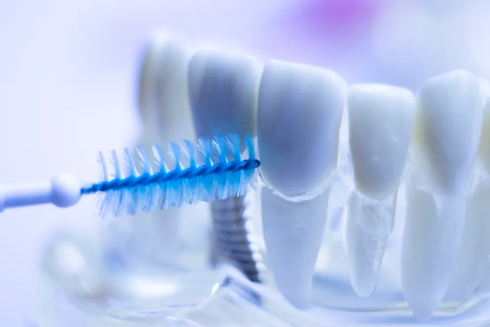 Na Buntáistí a bhaineann le Scuaba Interdental le haghaidh Fiacla